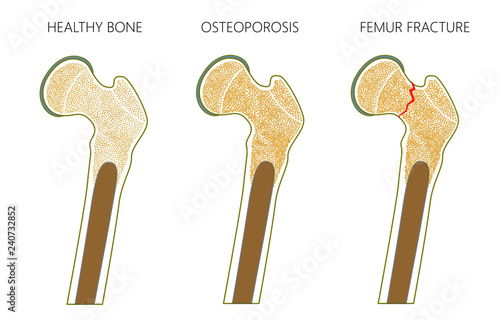 Vector illustration of a healthy human thigh bone,  osteoporosis of femur and femoral neck fracture without dislocation isolated on white background. For advertising and medical publications