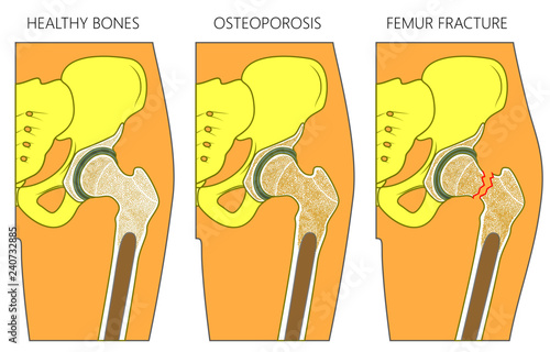 Vector illustration of a healthy human hip joint and bones,  osteoporosis of femur and femoral neck fracture with dislocation. For advertising and medical publications