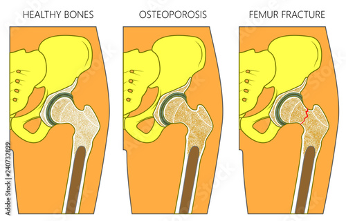 Vector illustration of a healthy human hip joint and bones,  osteoporosis of femur and femoral neck fracture without dislocation. For advertising and medical publications