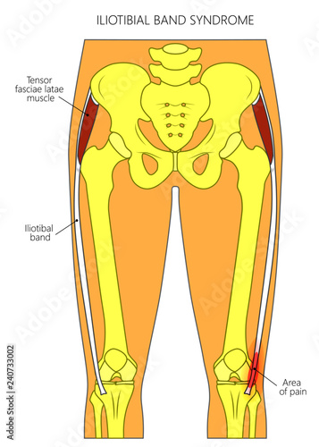 Vector illustration of a human pelvis, hip and a knee joint with iliotibial band (tract) syndrome. Front view. For advertising and medical publications photo
