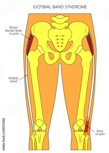 Vector illustration of a human pelvis, hip and a knee joint with iliotibial band (tract) syndrome. Front view. For advertising and medical publications