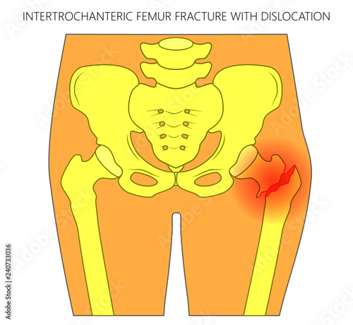 Vector illustration of healthy human hip and intertrochanteric femur fracture with dislocation. For advertising and medical publications
