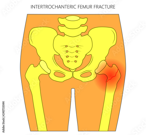 Vector illustration of healthy human hip and intertrochanteric femur fracture without dislocation. For advertising and medical publications