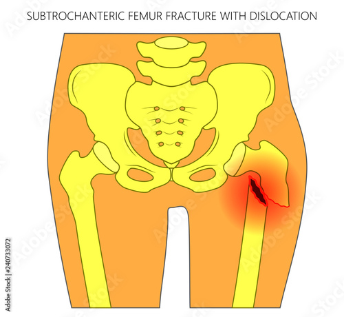 Vector illustration of healthy human hip and subtrochanteric femur fracture with dislocation. For advertising and medical publications