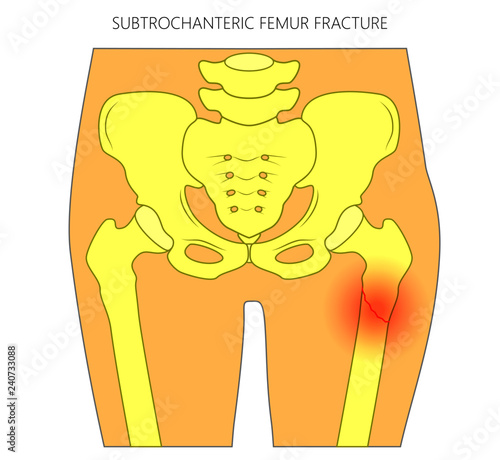Vector illustration of healthy human hip and subtrochanteric femur fracture without dislocation. For advertising and medical publications