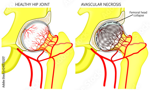 Vector illustration anatomy of a healthy human hip joint and a hip with avascular necrosis of the femoral head. Front view. For advertising and medical publications