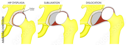 Vector illustration anatomy of a hip joint with dysplasia, subluxation and dislocation of the femoral head in the joint . Front view. For advertising and medical publications. photo