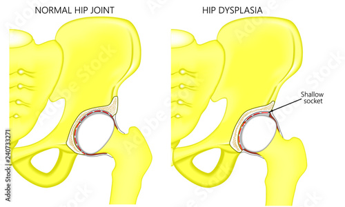 Vector illustration anatomy of a healthy human hip joint and hip with dysplasia. Front view. For advertising and medical publications