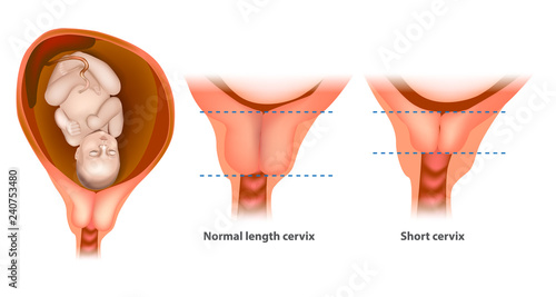 Normal length cervix and short cervix in Pregnancy. The cervix or cervix uteri photo