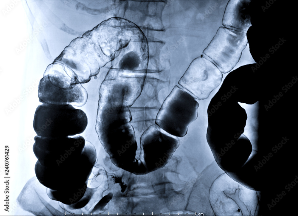 barium enema image is a rectal injection of barium contrast. This coats