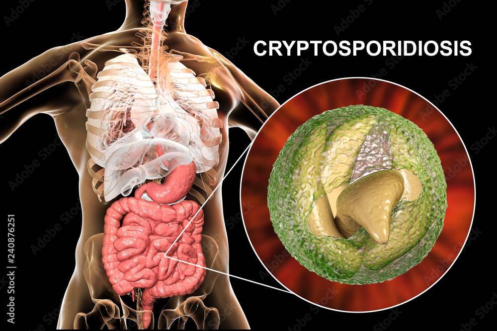 Cryptosporidiosis, a diarrheal disease caused by Cryptosporidium parvum