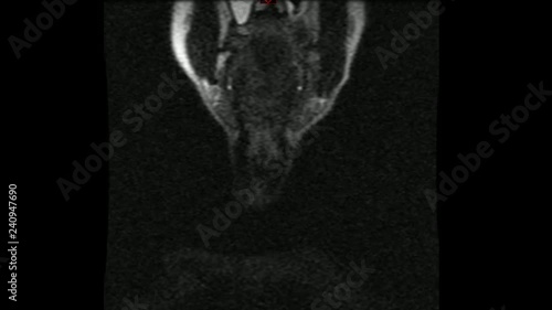 TAC tomografia assiale computerizzata rachide cervicale photo