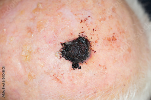 Tableau sur toile Malignant melanoma on the head of an old caucasian man