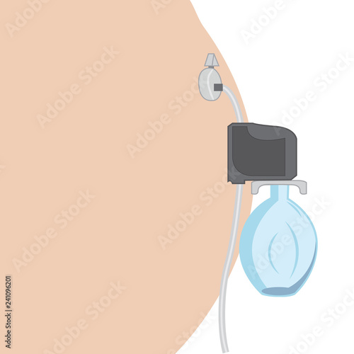 Aspire Assist for lose weight therapy