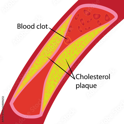 Blood clot and cholesterol plaque. Blocked blood vessel illustration