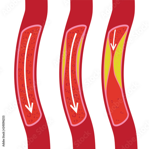 Healthy, partly blocked blood vessel and blocked blood vessel illustration
