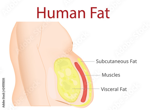 Body Fat, Liposuction, diet , surgery, exercise