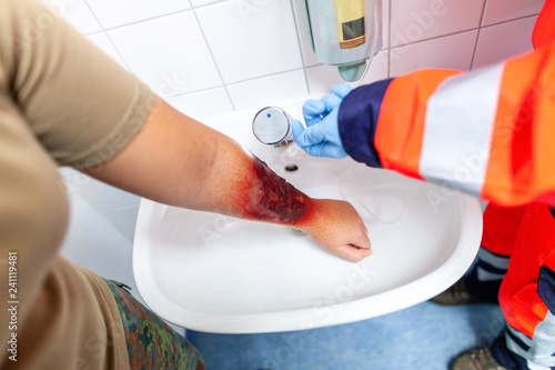 Paramedic cools a make up burn wound