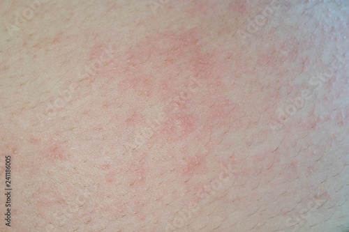 Valokuva an irritated skin during pregnancy