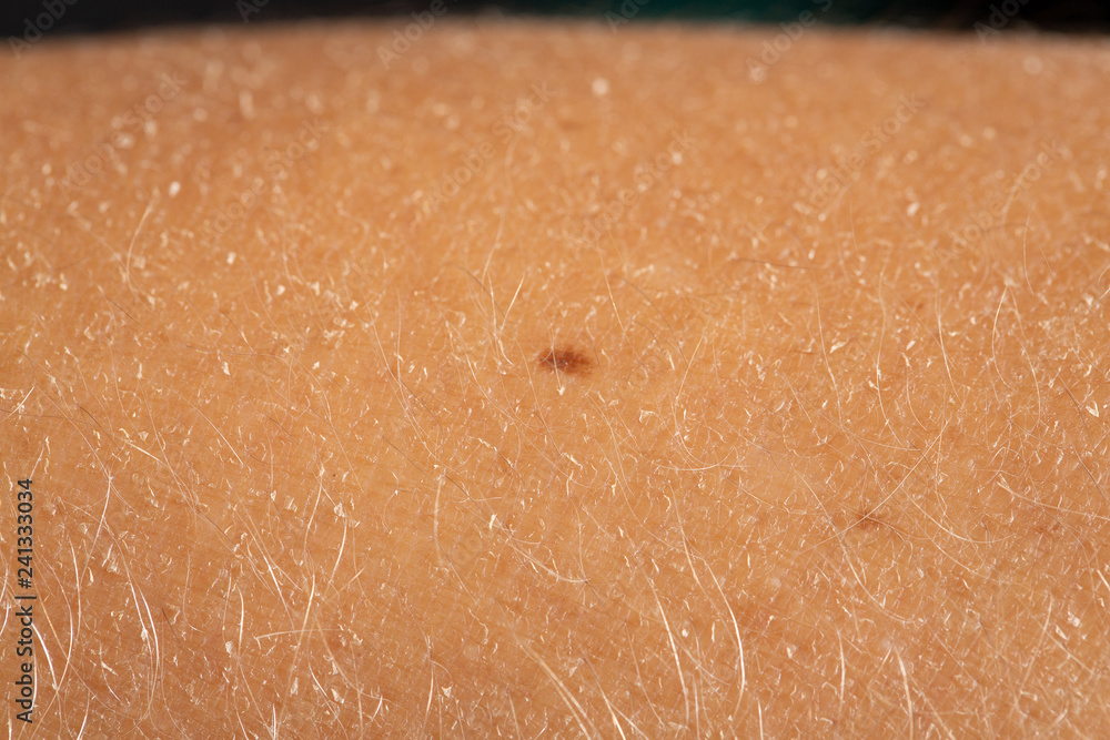 Fototapeta premium Closeup shot of skin blemishes