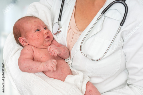 Doctor holding a newborn baby which is sick rubella or measles