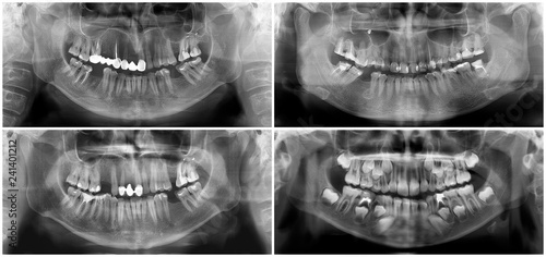 Panoramic dental x-ray digital image of upper and lower jaw. Radiograph scanning of maxilla and mandible. Focal plane tomography to thirty-year-old woman, forty-year-old man, child aged seven years