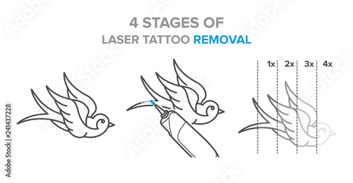 4 Stages of laser tattoo removal illustration, vector icons