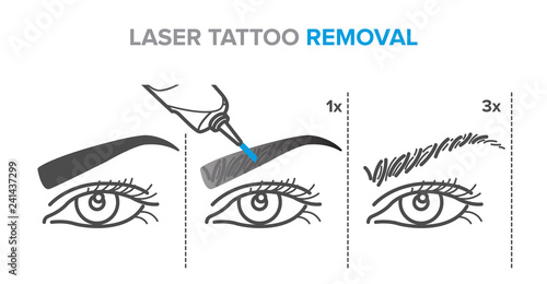 laser permanent makeup removal stages, eyebrow tattoo removal procedure