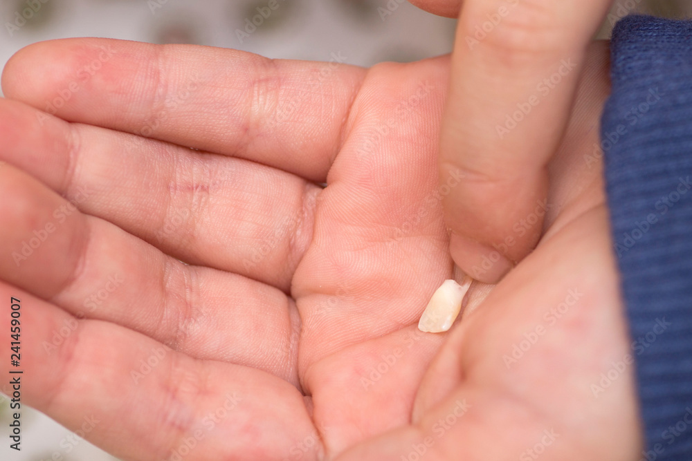The child holds a fallen tooth on the palm of his hand. Milk tooth on the palm. First tooth lost