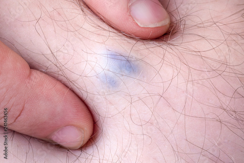 varicose vein disease in a man  closeup image