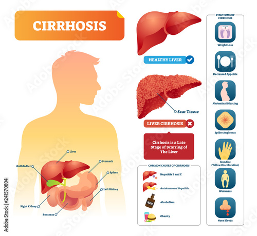 Cirrhosis vector illustration. Labeled medical diagram with illness symptom
