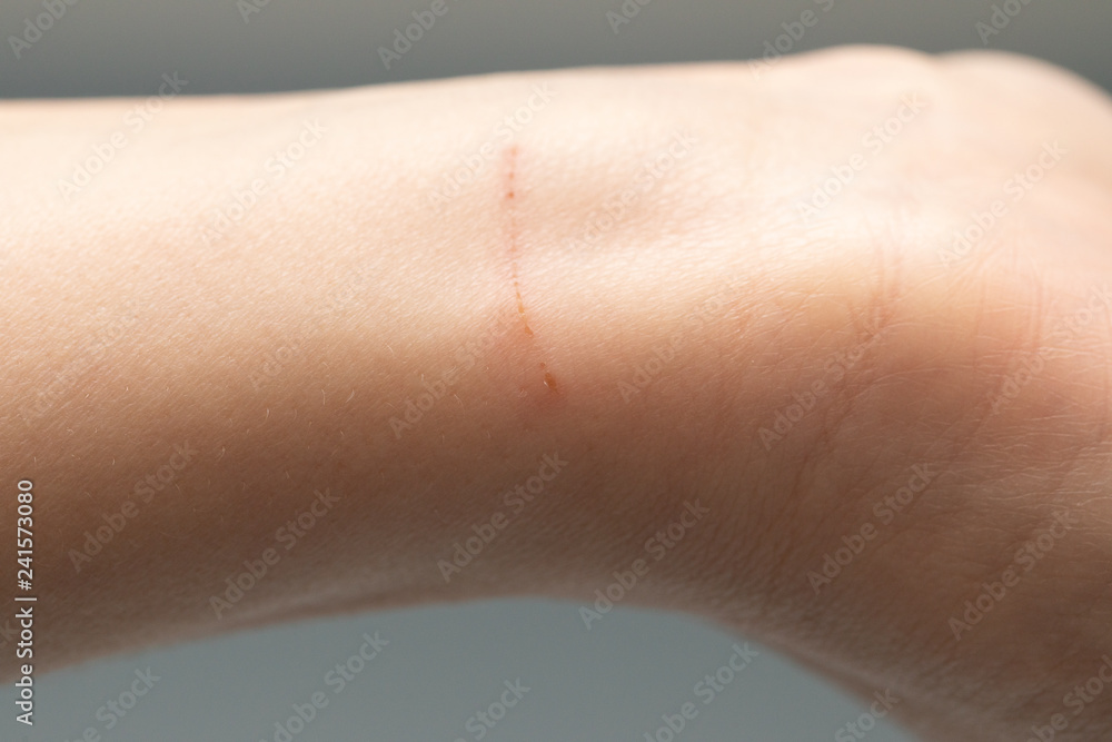 Fototapeta premium Healing cut on wrist