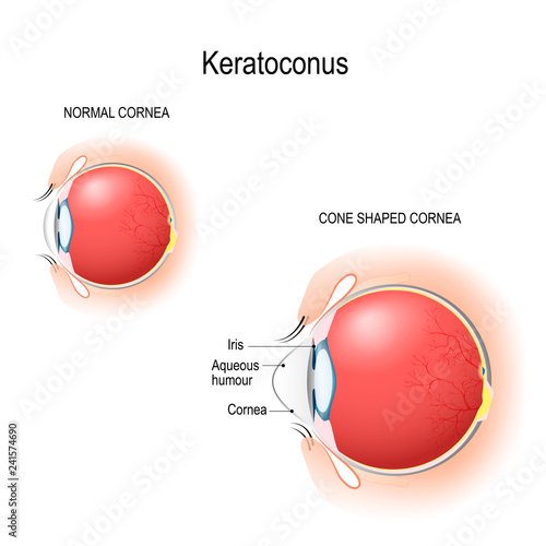 Keratoconus. Normal cornea and cone shaped cornea.