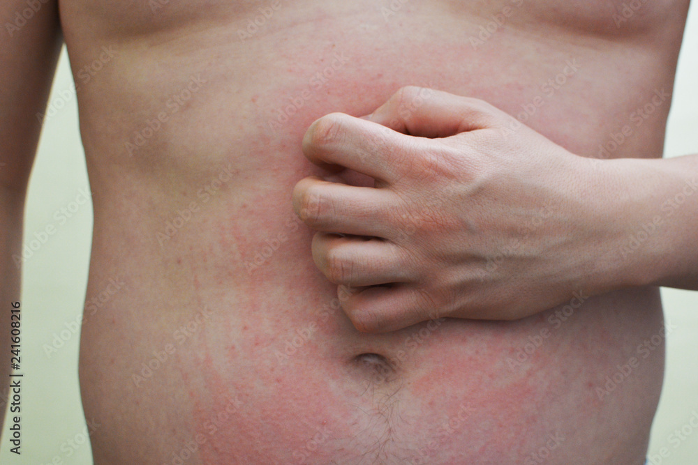 A man scratching an irritated stomach. Urticaria on his stomach.Allergic reaction.
