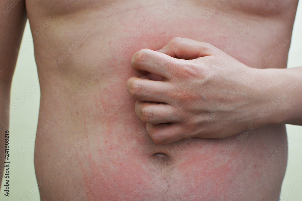 A man scratching an irritated stomach. Urticaria on his stomach.Allergic reaction. A man scratching an irritated stomach. Urticaria on his stomach.Allergic reaction.