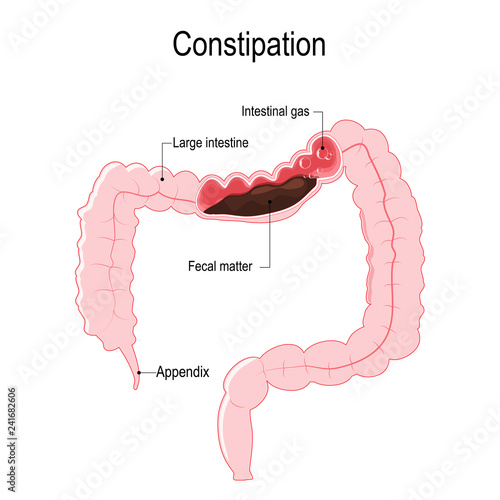 Constipation. Vector diagram represent the human large intestine with fecal matter and bowel gas bubbles