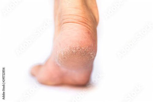 Close up of single female leg or heel showing dried  cracked heel with dried skin isolated on white concept of crack heels during winter season.  © mirzamlk