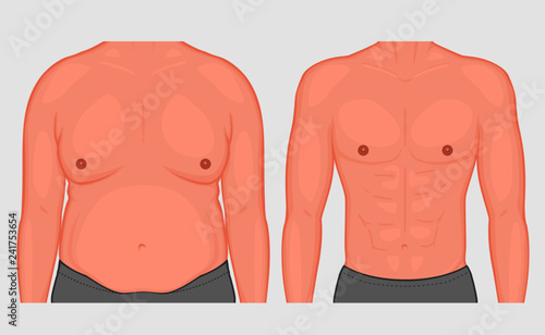 Vector illustration torso of a male before and after weight loss and sports. Front view. For medical publications and advertising of cosmetic, plastic procedures, stomach shunting, diet, sport