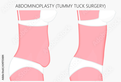 Realistic Vector illustration. Abdominoplasty, tummy tuck plastic surgery in woman.Side view. For advertising of cosmetic plastic procedures, stomach shunting, diet; for medical publications