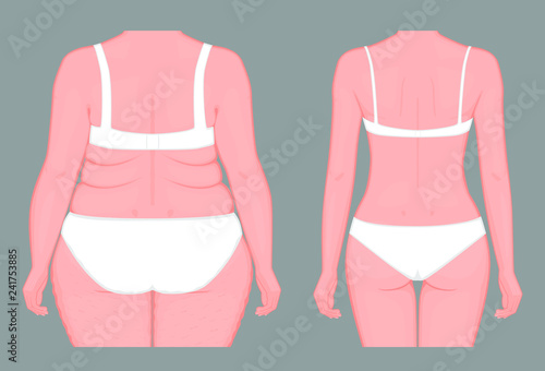 Vector illustration. Woman body problem obese, in European Asian female, weight loss to normal slim figure. Back view. Advertising of cosmetic plastic procedures,  diet, medical publications.