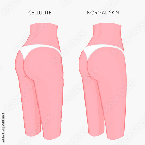 Vector illustration of woman body problem. Cellulitis on European, Asian female thighs, weight loss and normal skin. For advertising of anti cellulite procedures, medical publications, creams