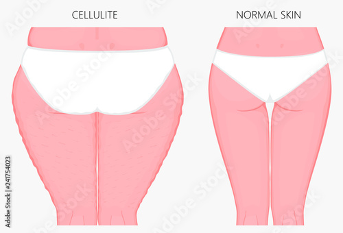 Vector illustration of woman body problem. Cellulitis on European, Asian female thighs, weight loss and normal skin. For advertising of anti cellulite procedures, medical publications, creams