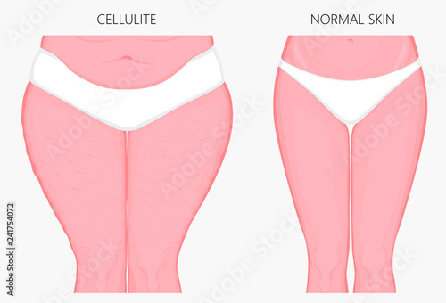 Vector illustration of woman body problem. Cellulitis on European, Asian female thighs, weight loss and normal skin. For advertising of anti cellulite procedures, medical publications, creams