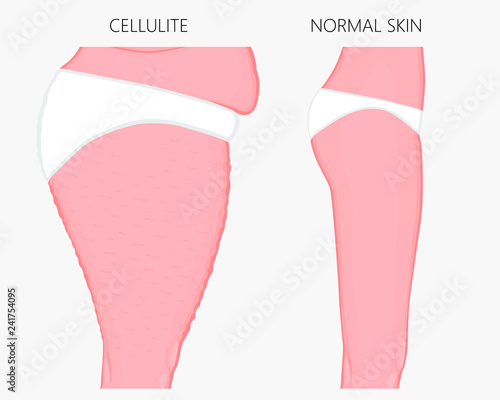 Vector illustration of woman body problem. Cellulitis on European, Asian female thighs, weight loss and normal skin. For advertising of anti cellulite procedures, medical publications, creams
