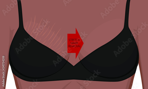 Vector illustration of woman body problem. Stretch mark removal on African, American, Indian female breast. For advertising, medical publications, use on package of medicinal products, creams