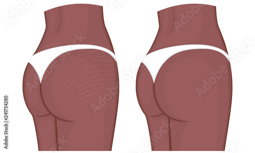 Vector illustration. Woman body problem Stretch marks on African American Indian female thighs and lower back. For advertising, medical publications, use on package of medicinal products, creams photo