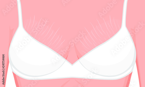 Vector illustration of a human body problem. Stretch marks on European, Asian female or woman breast. For advertising, medical publications, use on package of medicinal products, creams, lotion