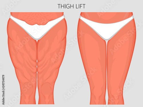 Vector illustration of a human body problem - fatty thighs and sagging skin correction before and after plastic thigh lift surgery. Front view. For advertising and medical publications