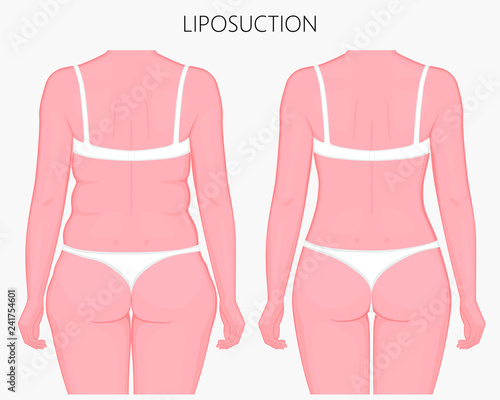 Realistic Vector illustration. Liposuction, waist, hips, buttocks and thighs plastic surgery in woman.Back view. For advertising of esthetic cosmetic procedures; for medical publications