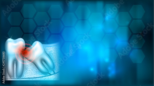 Wisdom tooth eruption problems illustrated anatomy on an abstract blue background